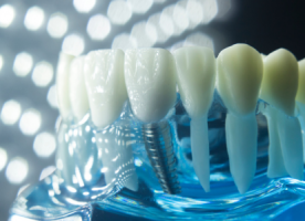 种牙告别万元时代 欧美品牌集采价遭腰斩